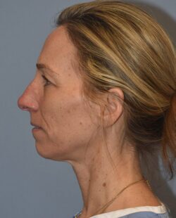 Facelift