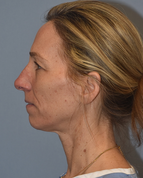 Facelift