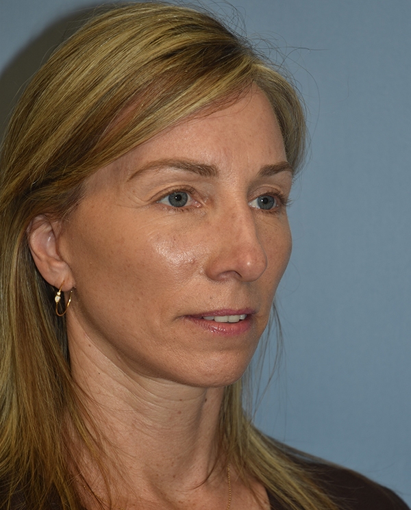 Facelift