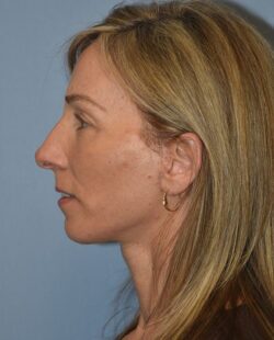 Facelift