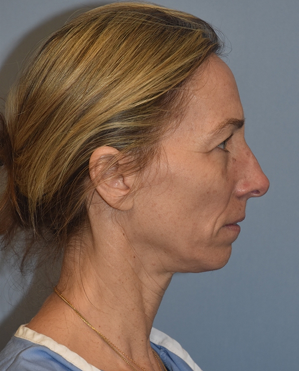 Facelift