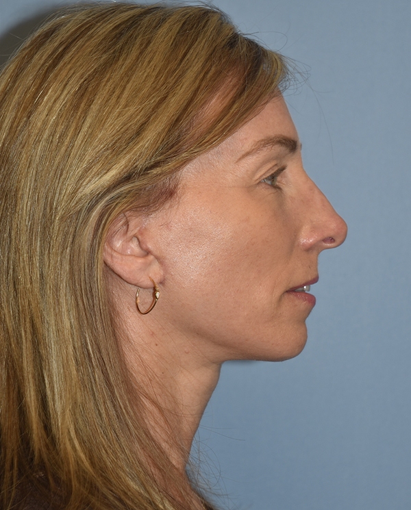 Facelift