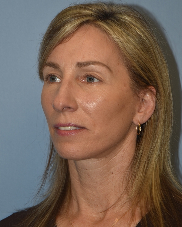 Facelift