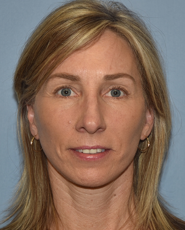 Facelift