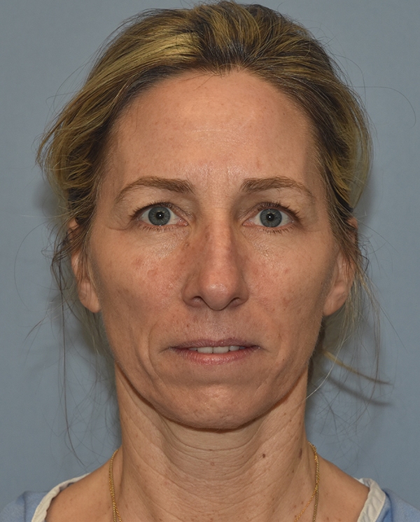 Facelift
