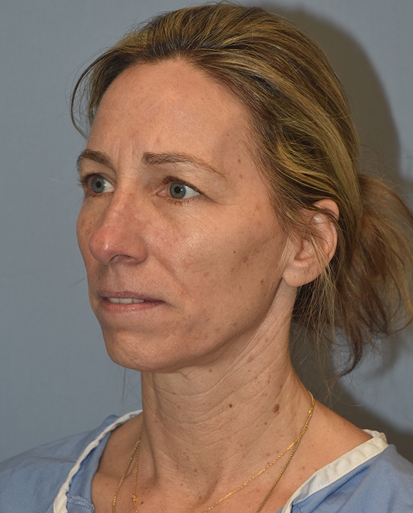 Facelift