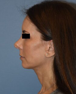 Facelift