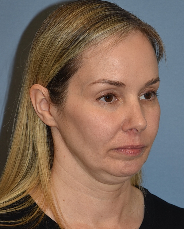Facelift
