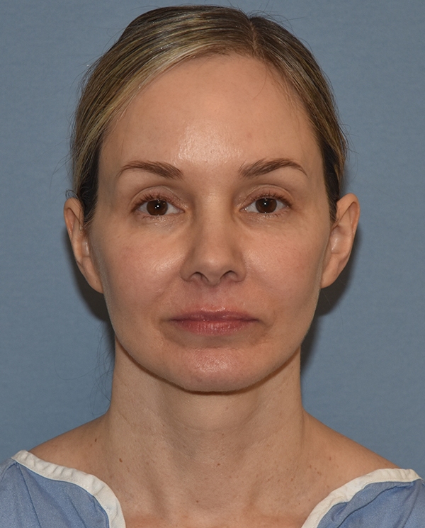 Facelift
