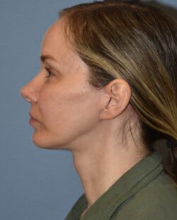 Facelift