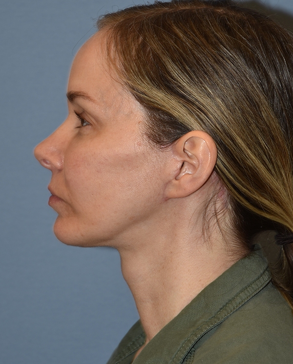 Facelift