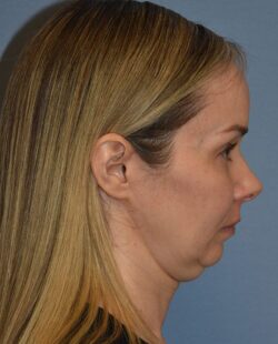 Facelift