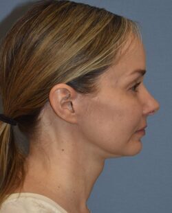 Facelift