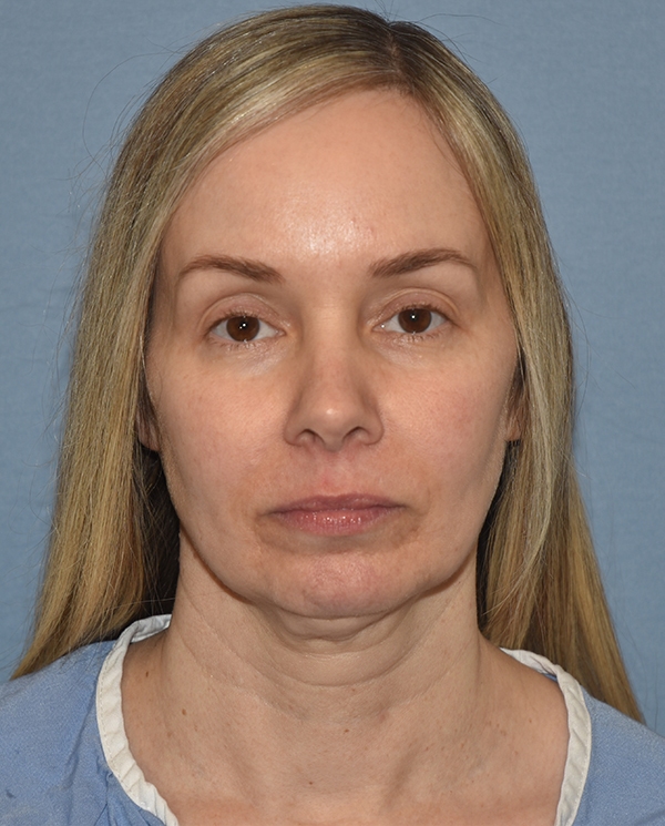 Facelift