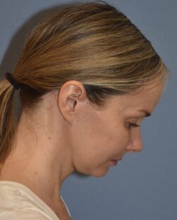 Facelift