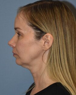 Facelift