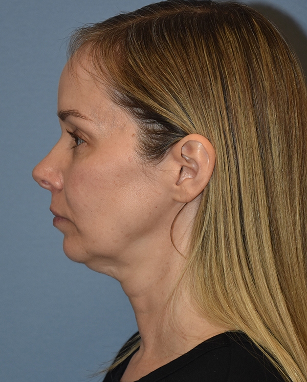 Facelift