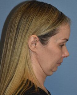 Facelift