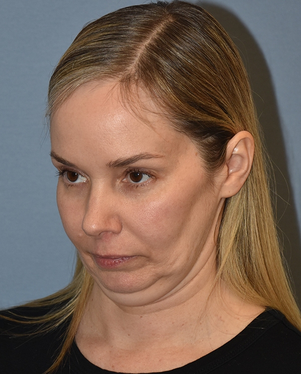 Facelift
