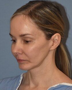 Facelift